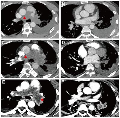 Case report: Pulmonary artery sarcoma diagnosed through rare brain metastases